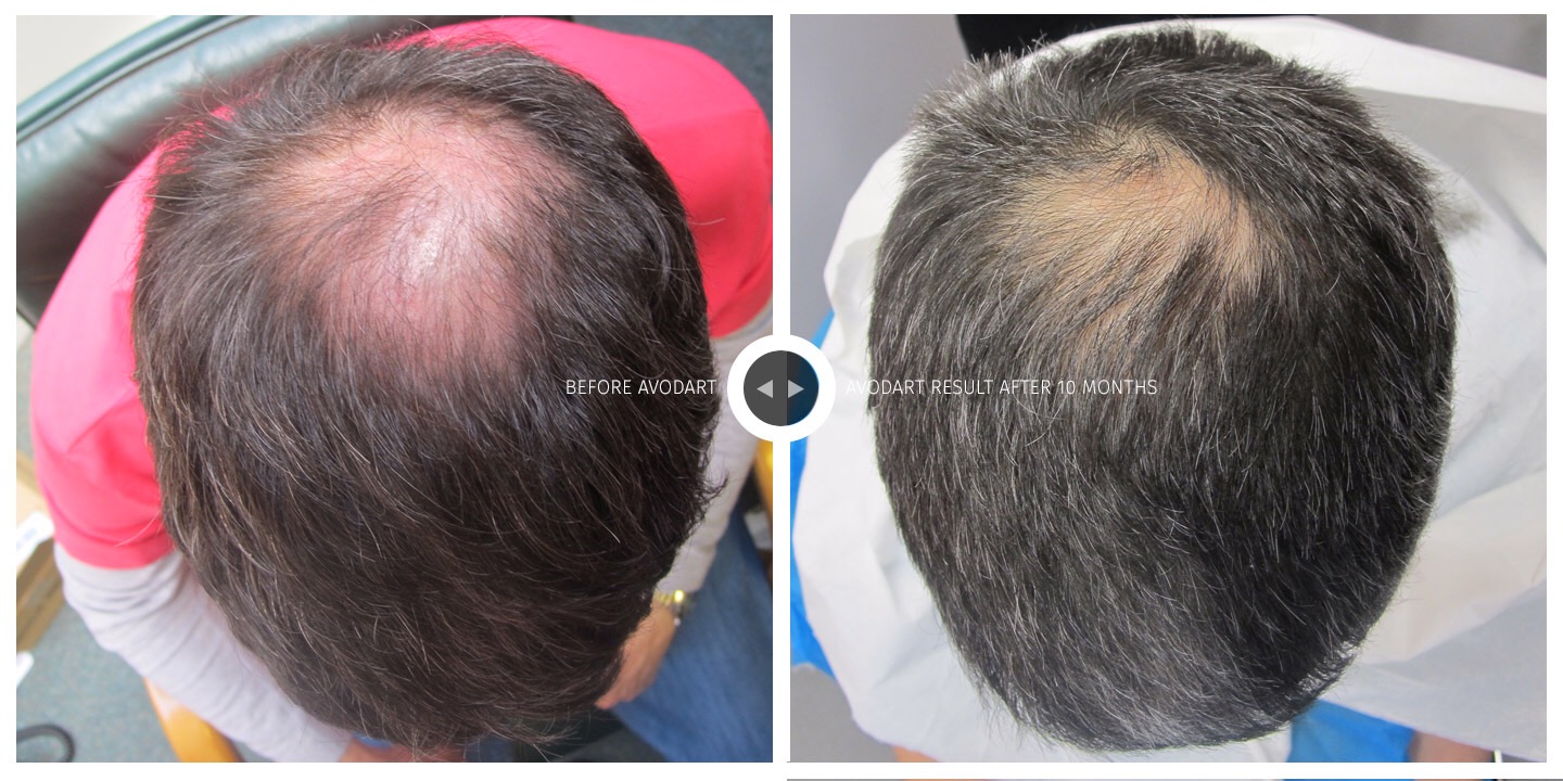 Will I need more than one hair transplant? | FUE Clinics