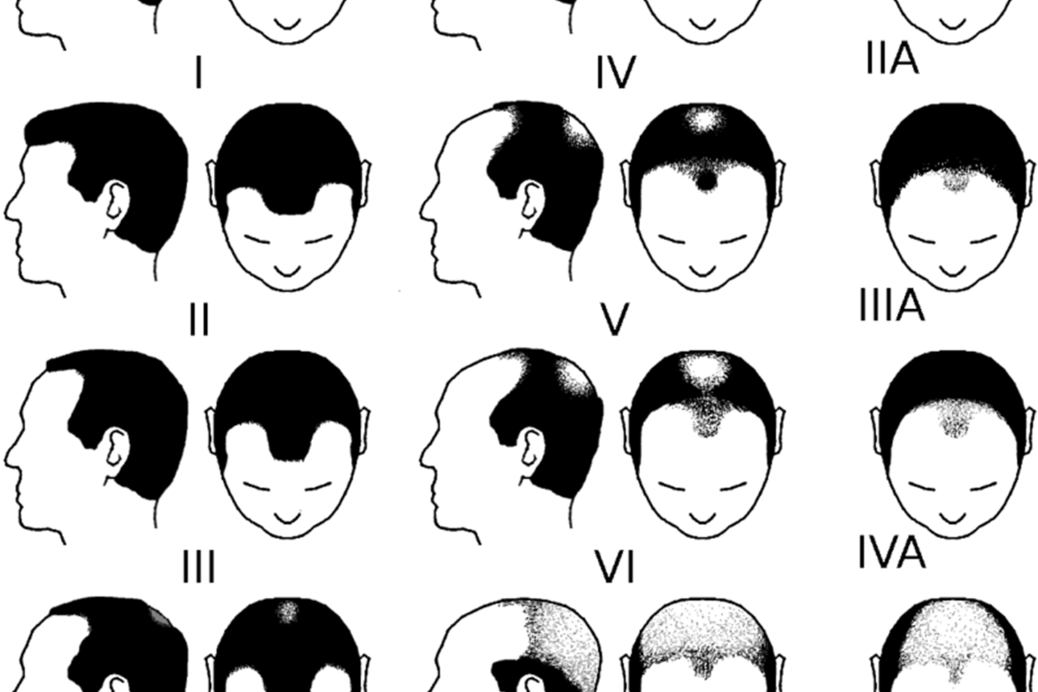 7 Receding Hairline Stages The Norwood Scale Explained TPLD 7-receding-hairline-stages-the-norwood-scale-explained-tpld