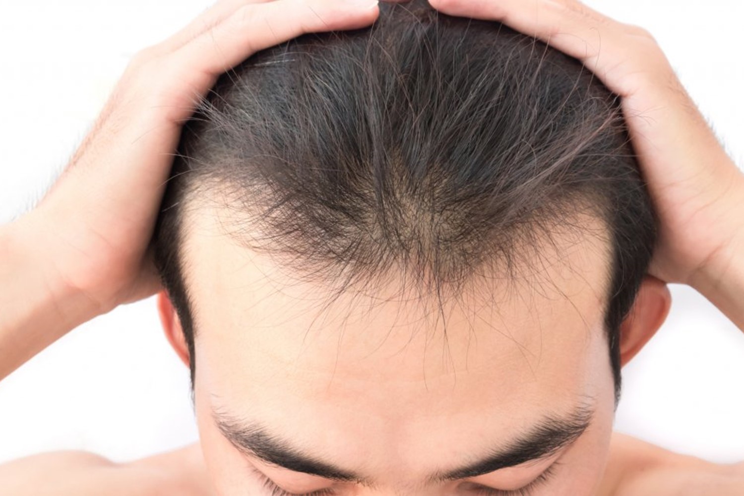 The Ultimate Guide to Hair Loss Treatment - FUE Clinics The Ultimate Guide to Hair Loss Treatment - FUE Clinics