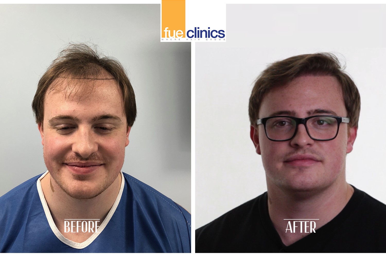 Everything You Need to Know About Hair Transplant Surgeries | FUE Clinics Everything You Need to Know About Hair Transplant Surgeries | FUE Clinics